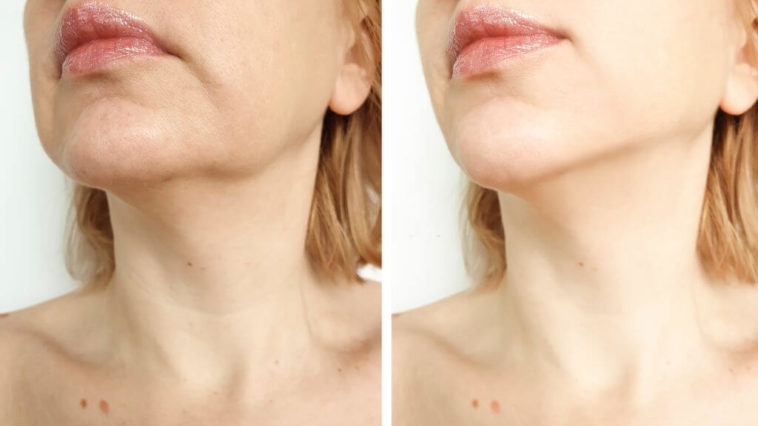Easy Tips to Get Rid Of a Double Chin