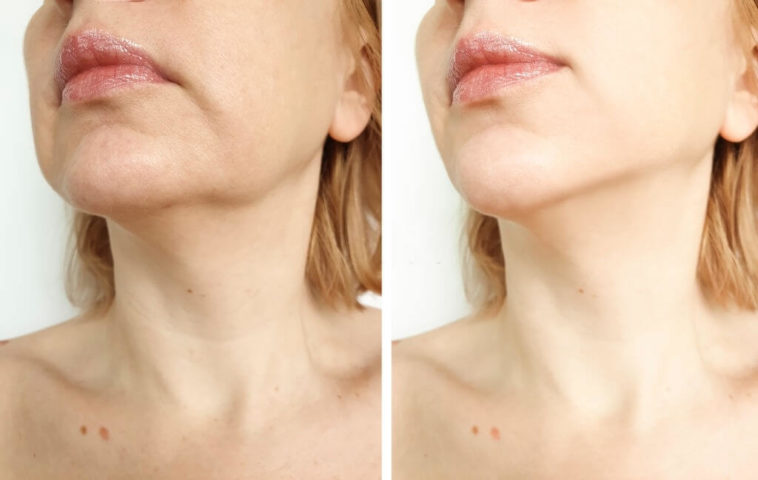 Easy Tips to Get Rid Of a Double Chin