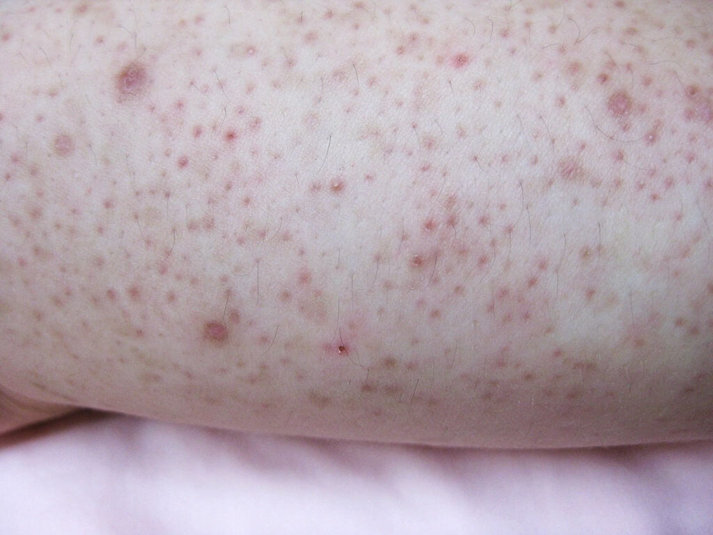 Keratosis pilaris