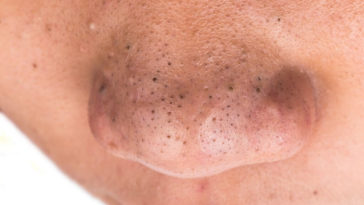remove blackheads