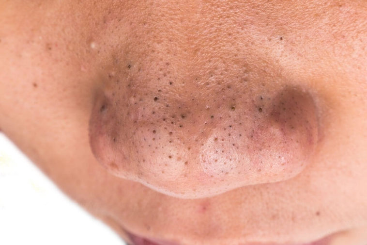 remove blackheads