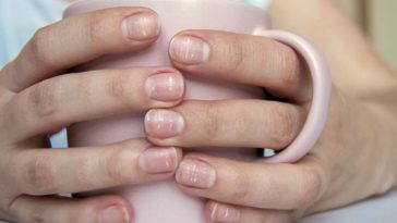 What White Spots on Nails Can Tell You About Your Health