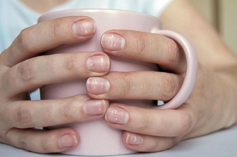 What White Spots on Nails Can Tell You About Your Health