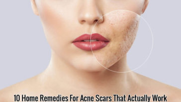 Home Remedies For Acne Scars