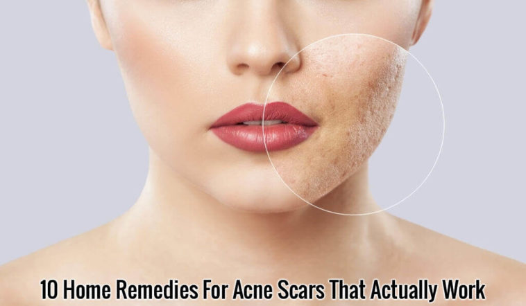 Home Remedies For Acne Scars