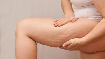 cellulite , cellulite treatment , laser cellulite removal near me , cellulite treatment near me , cellulite reduction treatment near me , cellulite removal near me , what cellulite , anti cellulite treatment near me , butt dimples , cryoskin cellulite before and after , weight loss cellulite before after , cellulite laser treatment near me , cellulite cause