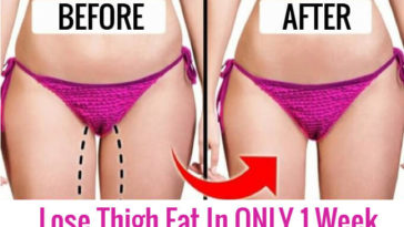 reduce thigh fat at home , thigh fat , coolsculpting legs cellulite , coolsculpting on legs , inner thigh coolsculpting before and after , coolsculpting thighs before and after , saddlebag fat , lose thigh fat , inner thigh fat , lose leg fat