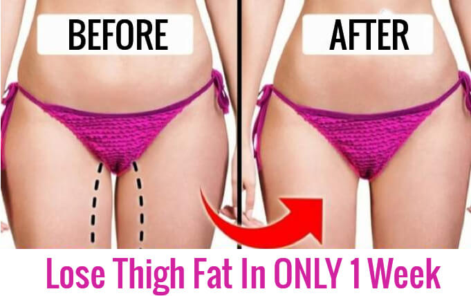 reduce thigh fat at home , thigh fat , coolsculpting legs cellulite , coolsculpting on legs , inner thigh coolsculpting before and after , coolsculpting thighs before and after , saddlebag fat , lose thigh fat , inner thigh fat , lose leg fat