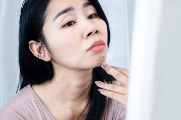 chin blackhead
