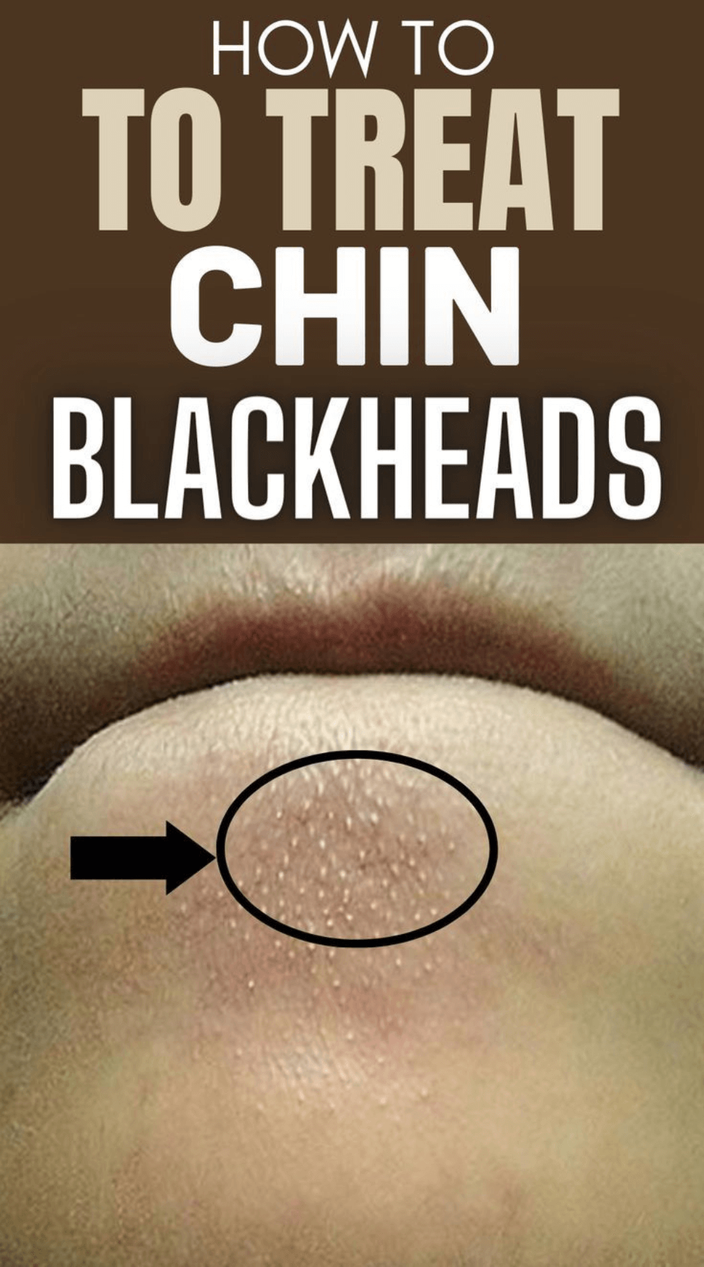 treat chin blackhead