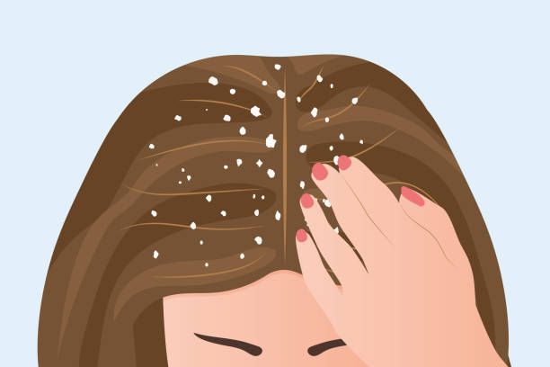 get rid of dandruff