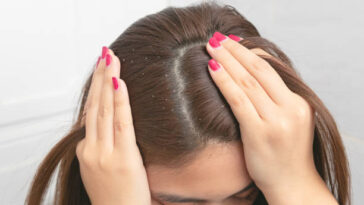 get rid of dandruff