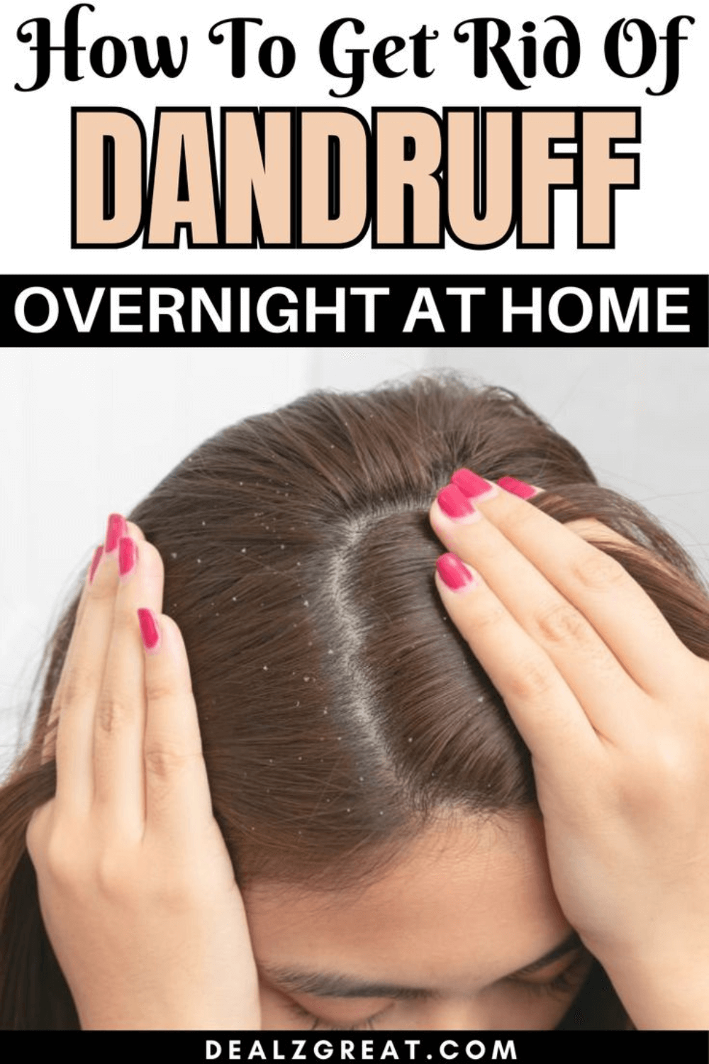 how to get rid of dandruff
