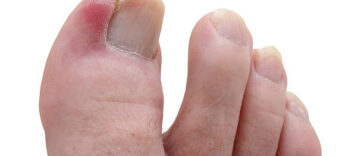 ingrown toe nails