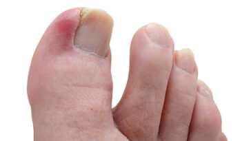ingrown toe nails
