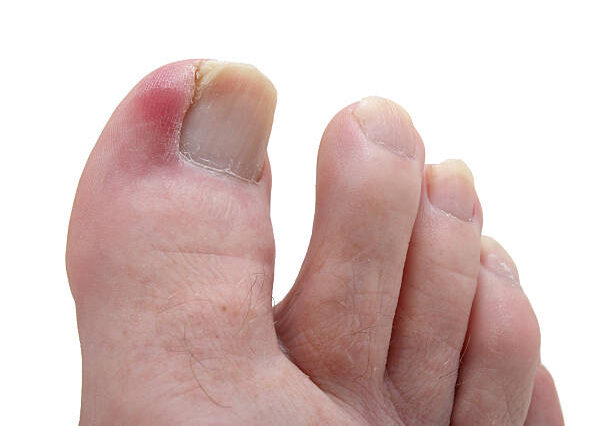 ingrown toe nails