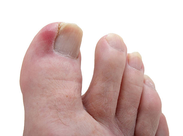 ingrown toe nails