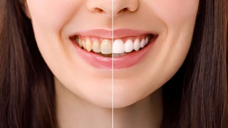 Teeth Whitening at Home