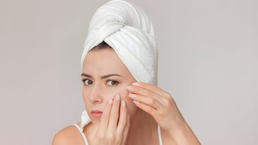 Skincare Routine for Acne Beginners