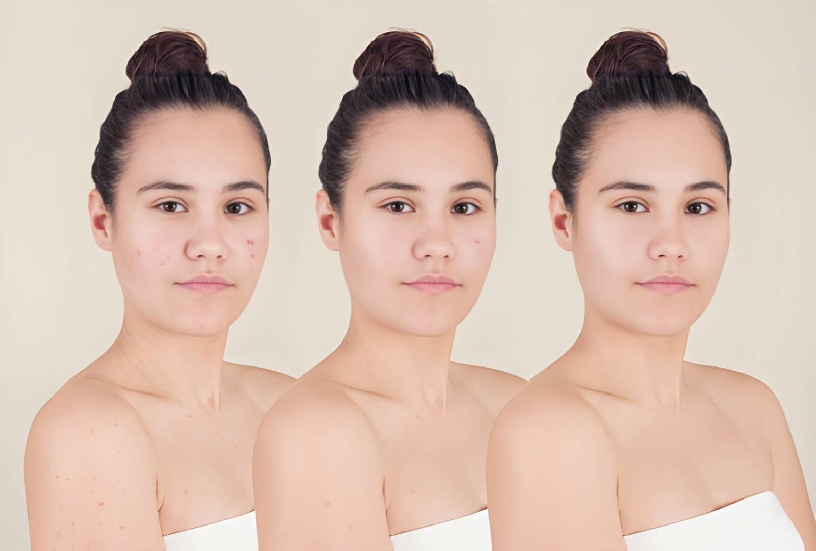 ane before and after treatement